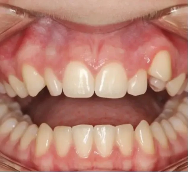 Before — crowded teeth corrected with Invisalign at Valley Smiles Dental