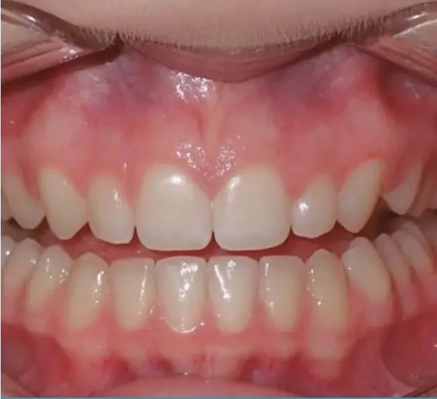 After — straight, beautifully aligned smile with Invisalign at Valley Smiles Dental