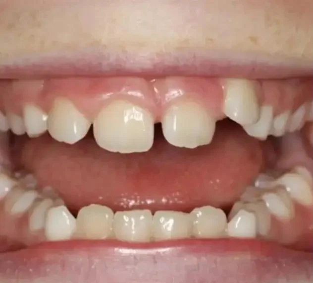 Before — gapped teeth aligned with Invisalign at Valley Smiles Dental