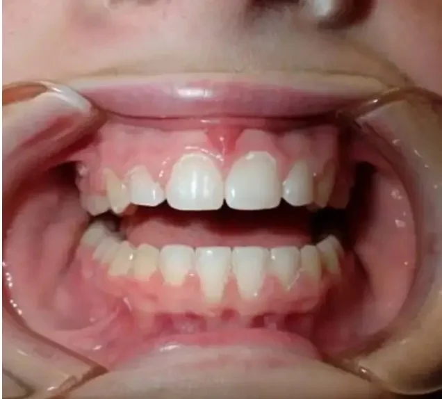 After — gaps closed with a straight, even smile using Invisalign