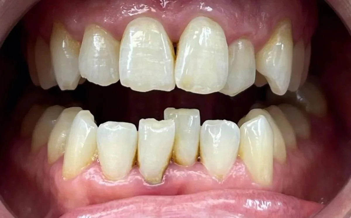 Before — misaligned bite corrected with Invisalign at Valley Smiles Dental