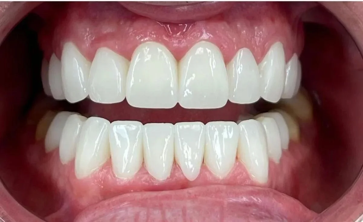 After — corrected bite and beautifully straight smile with Invisalign